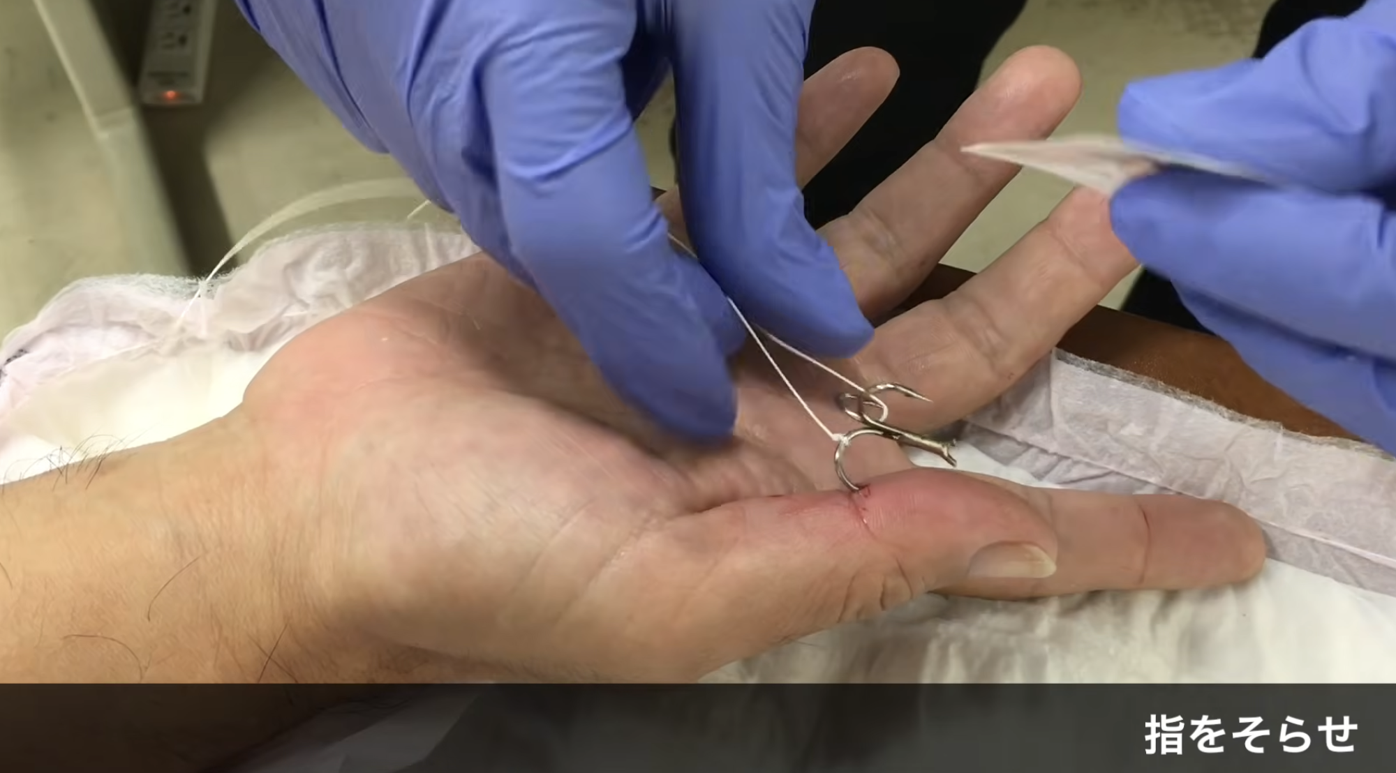 釣針刺傷 string yank technique